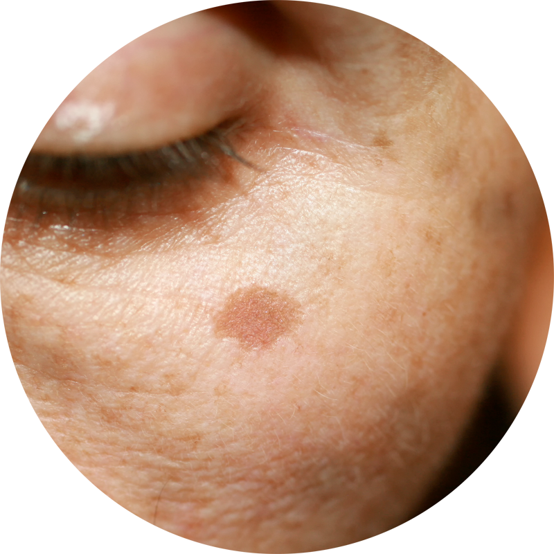 Age spots & Sun Spots Removal in Armagh
