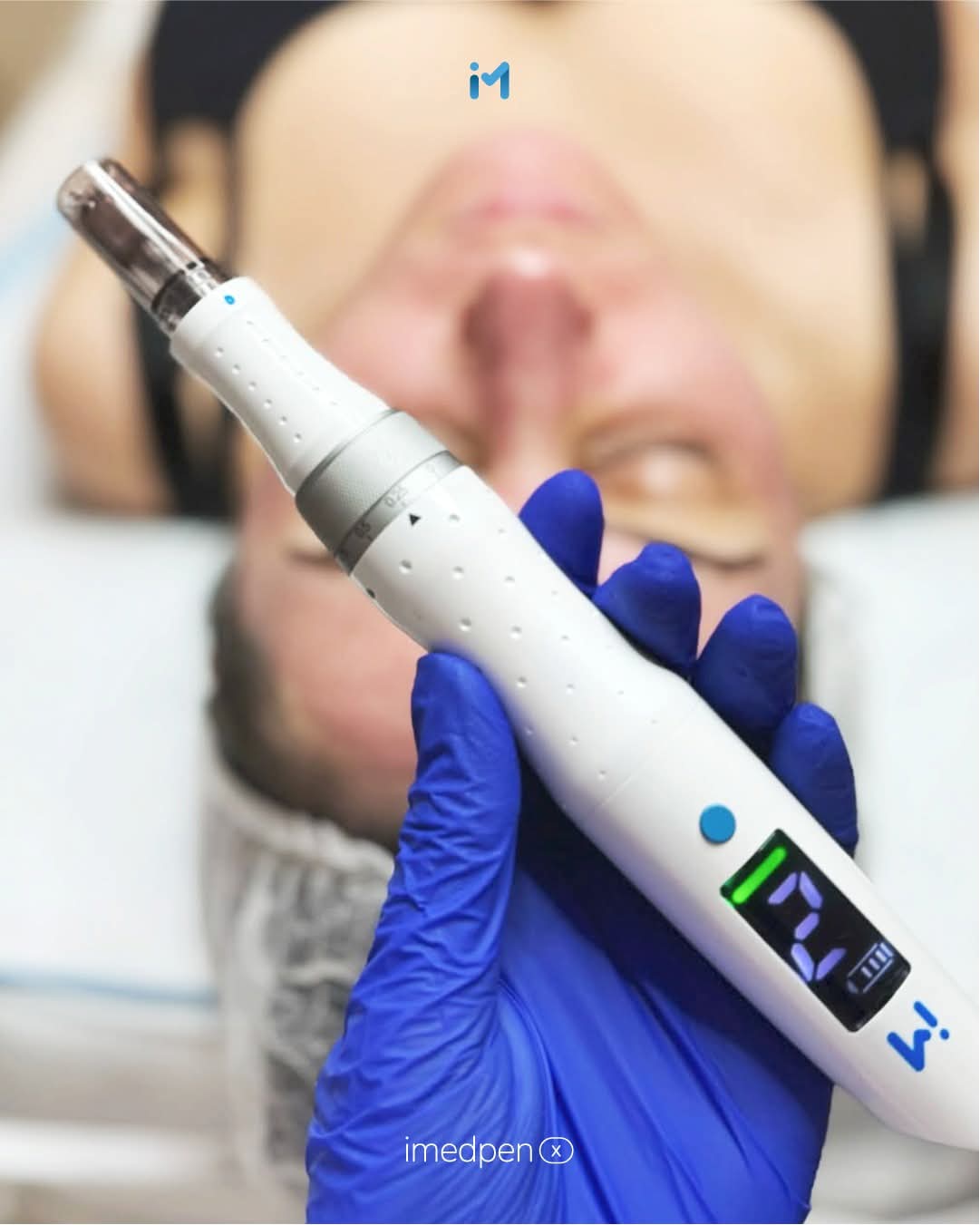 Microneedeling Ivanmed Glide treatment in Armagh