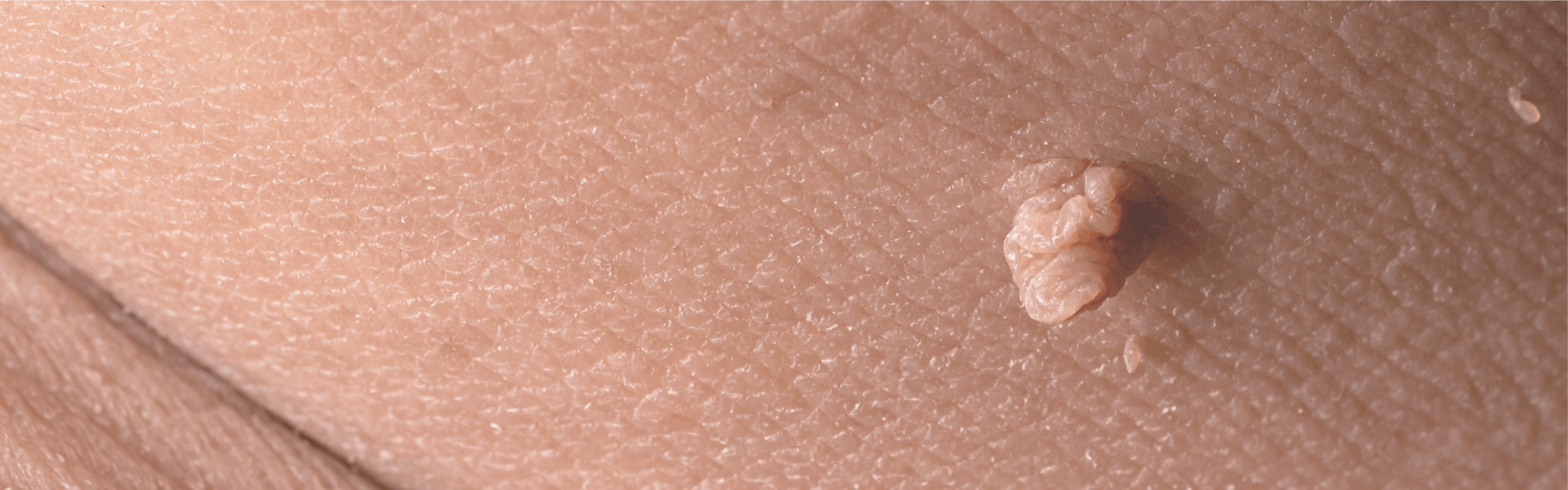 Cryotherapy for Skin in Armagh