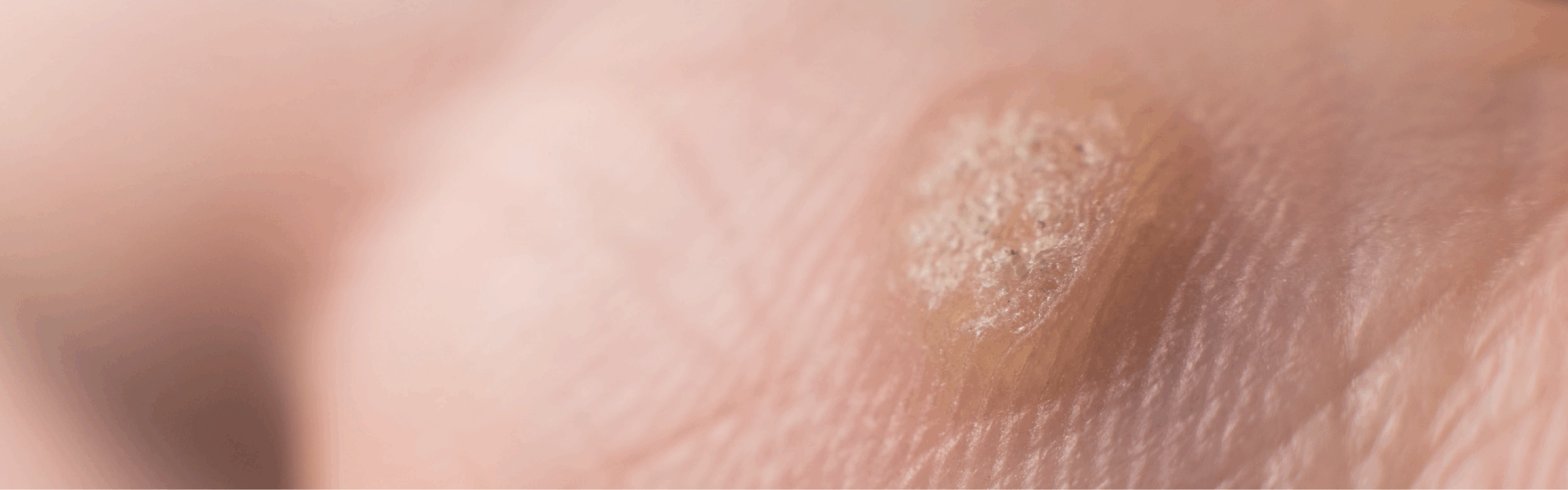 Wart & Verruca Removal in Armagh