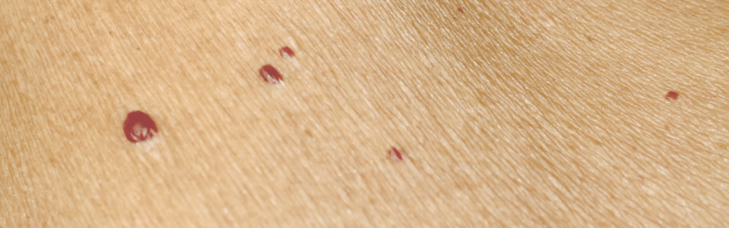 Cherry Angioma Removal in Armagh