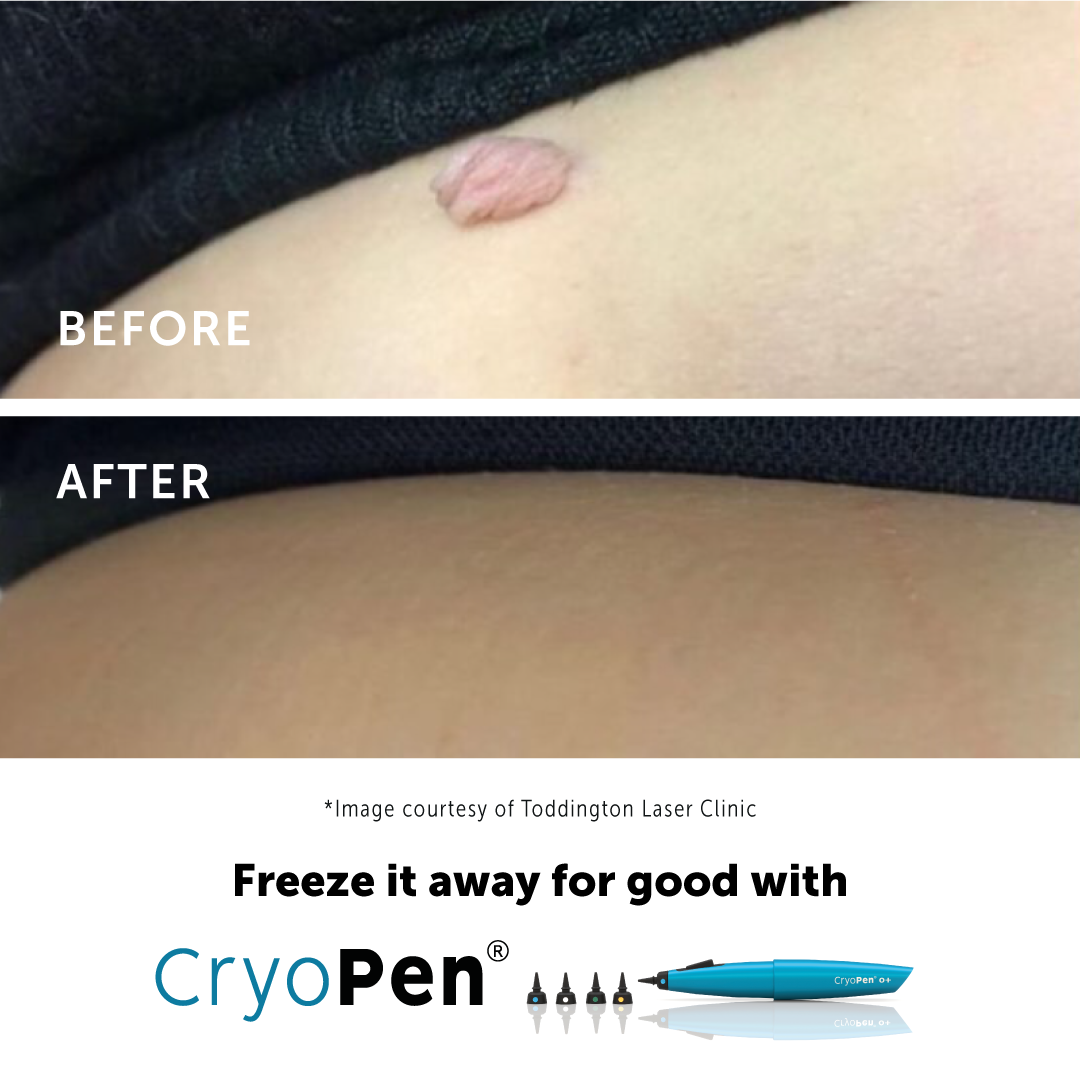 Skin Tag Removal in Armagh | Cryotherapy Treatment