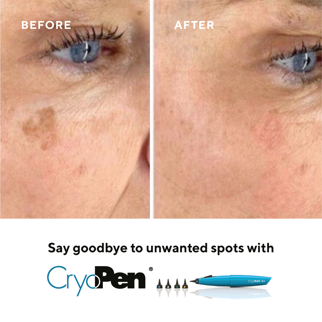 Cryotherapy in Armagh