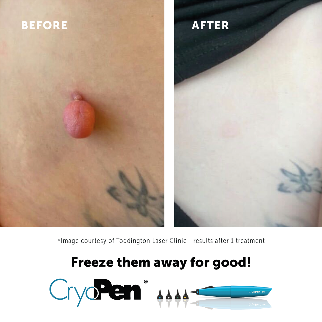 Wart & Verruca Removal in Armagh