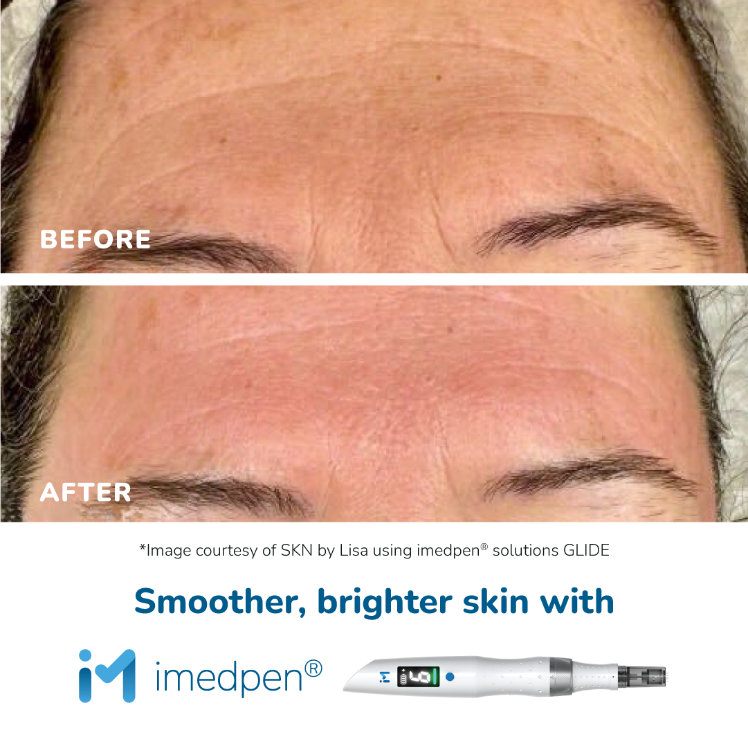 Microneedling vs express glow facial, microneedling