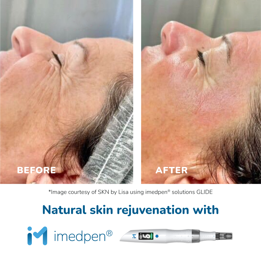 microneedling, skin looks tired, skin refresh