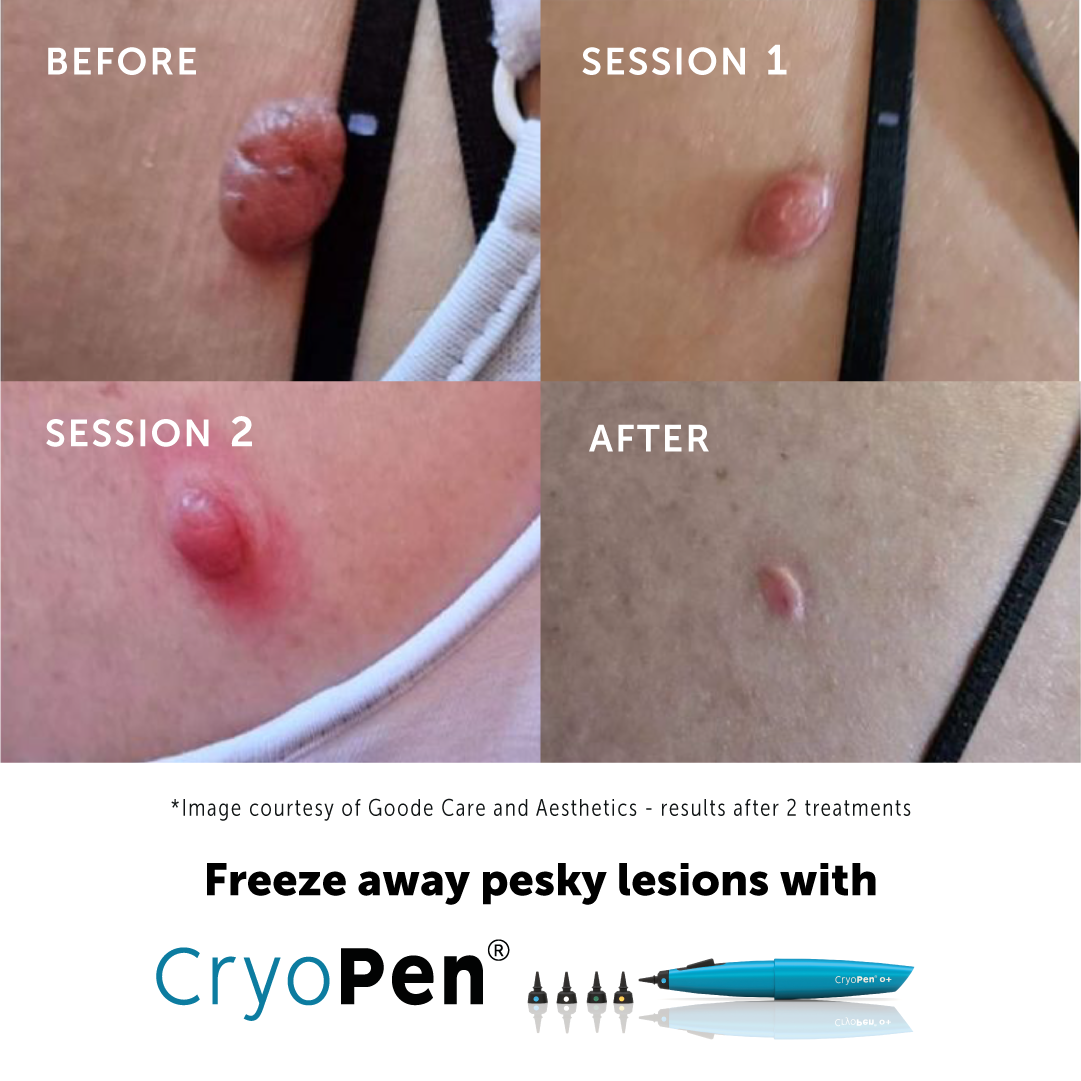 does cryotherapy hurt