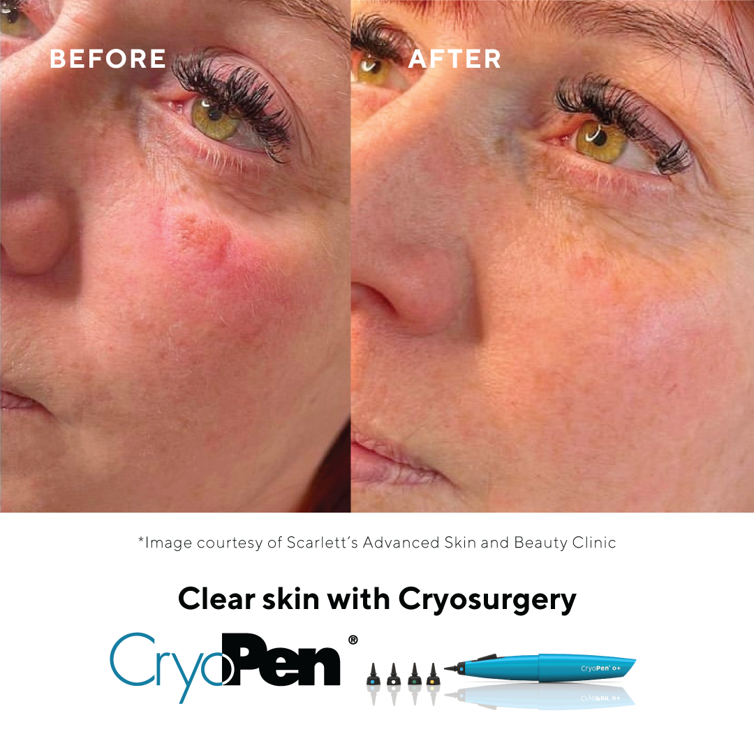 what is cryotherapy.